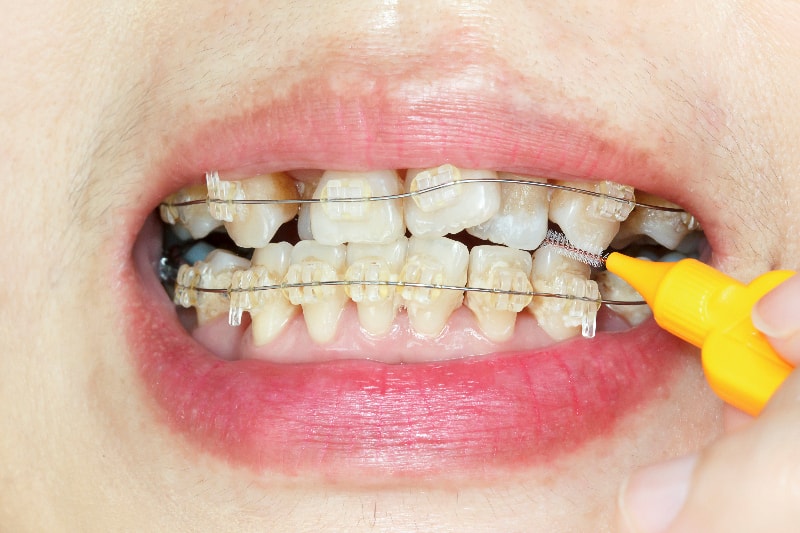 本格的な矯正装置を使って歯を動かします